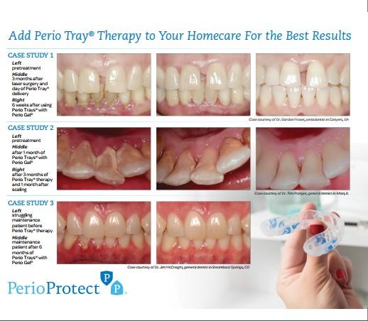 What home care can achieve and what requires professional periodontal therapy